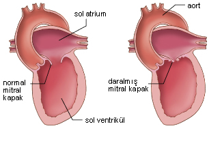Kalp Kapak Hastalıkları (Yetmezlikler ve Darlıklar)
