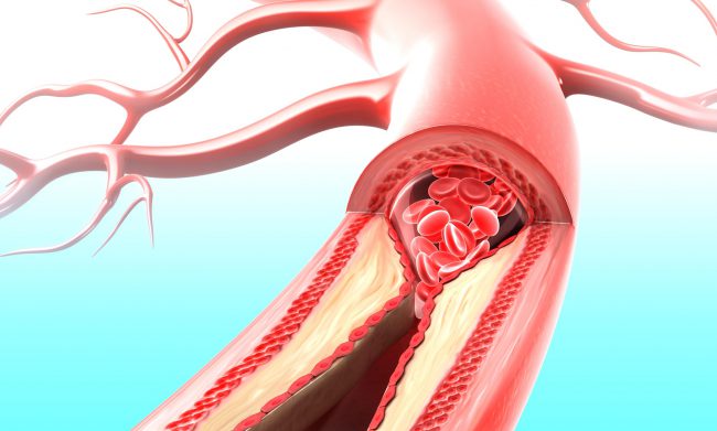 Periferik Damar Hastalığı